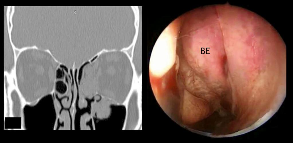ethmoidal and maxillary mucosal thickening, respectively. (C, D) Endoscopic images revealed left-sided (LT) agger nasi (N) cells.