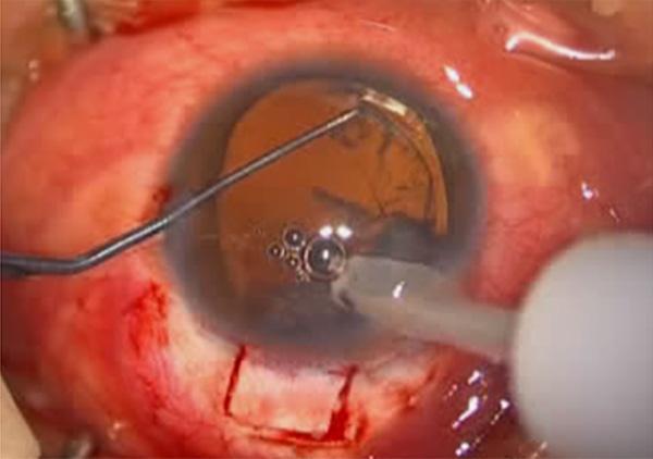 Insertion of capsular tension ring into the capsular bag with forceps. Figure 3.
