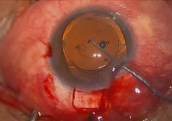 IOL (PCIOL) implantation in the empty capsular bag after lens extraction. Figure 6.