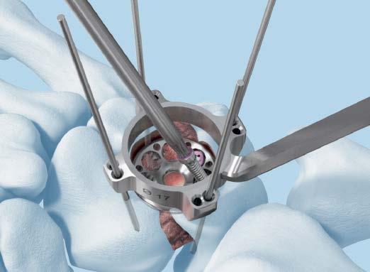 Plate Fixation Insert a second VA Locking screw in the lunate (Figure