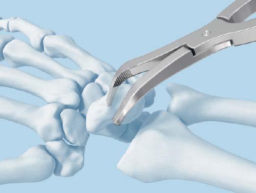 Ensure that sclerotic and dense subchondral bone is removed down to cancellous bone. Complete debridement of the midcarpal joint is mandatory.