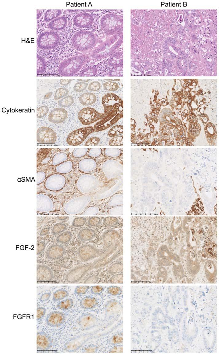 Supplementary Figure S9: Representatives images of FGF-2 and FGFR1 expression in human colon cancer.