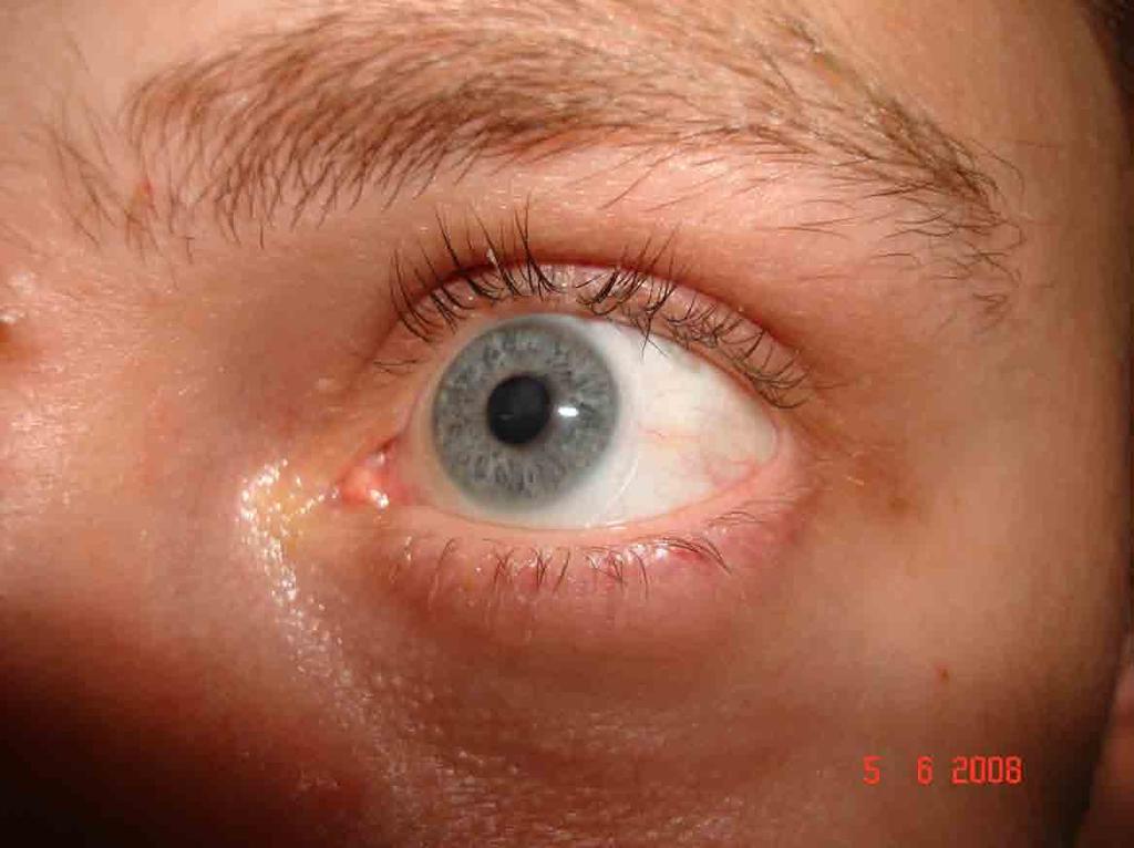 OCULAR PATHOLOGY - TCL USED FOR WOUND HEALING Herpes