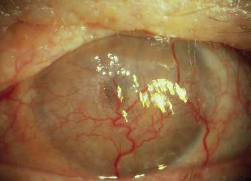 ) Pathologic Ocular Surface Disease Chemical Burns Ocular Pemphigoid