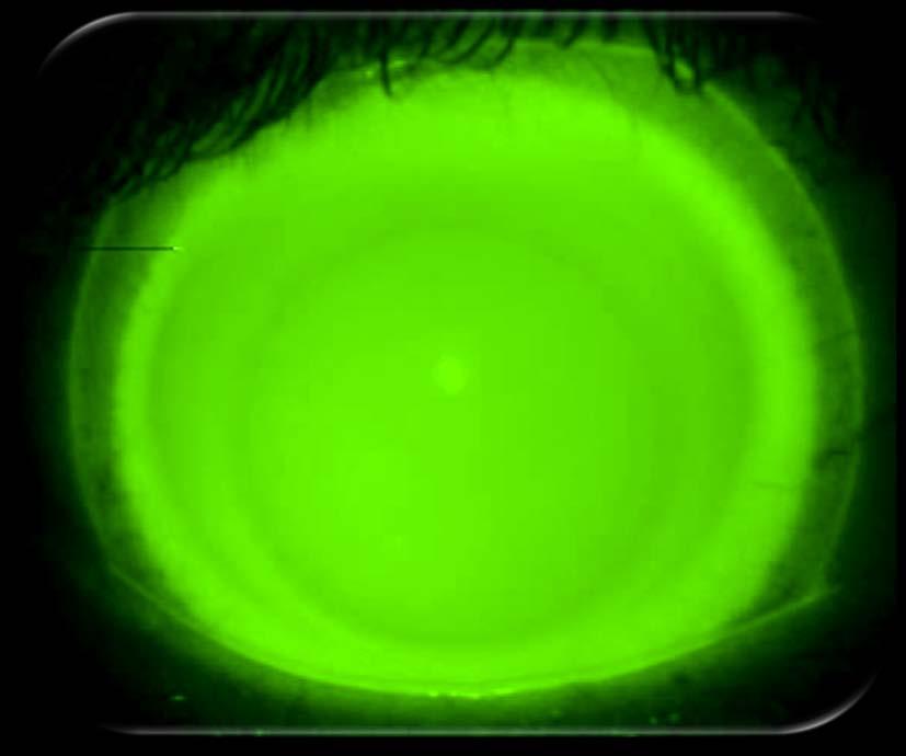 Scleral Lens Fitting Objectives 1. Central Vault Zone (250 to 400 microns) 2.
