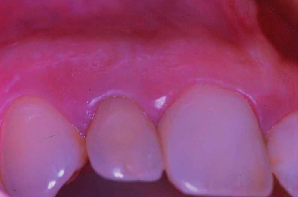 inflammation in the buccal region of the maxillary right lateral incisor.