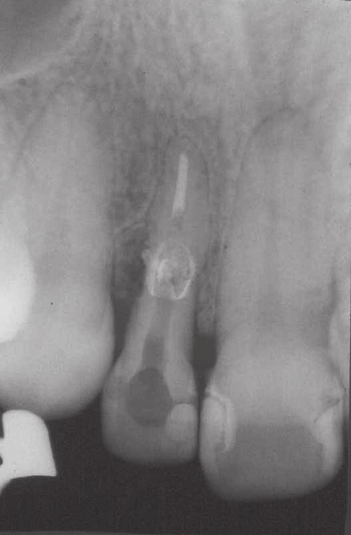 129 Fig. 6 Apical root canal filling. Fig. 7 MTA inserted into the resorption area. Fig. 8 Radiographic examination after 11 years and 8 months revealed bone formation lateral to the resorption area.