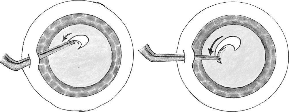 Management of Radial Tears FIGURE 1. Starting the capsulorhexis in an anticlock wise direction.