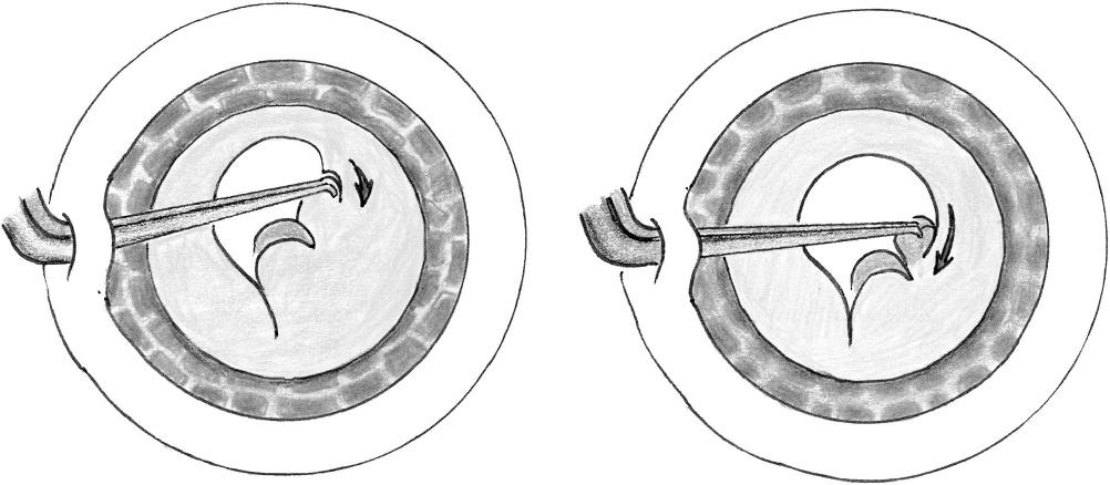 Mohammadpour FIGURE 3. Starting the capsulorhexis from the opposite direction. cortex and anterior capsule.