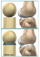 The menisci actually wrap around the round end of the upper bone to fill the space between it and the flat shinbone.