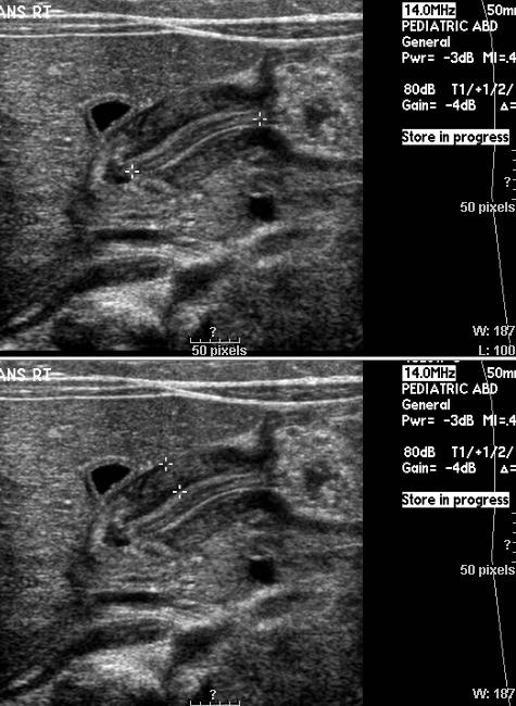 Pyloric Ultrasound Elongated pyloric