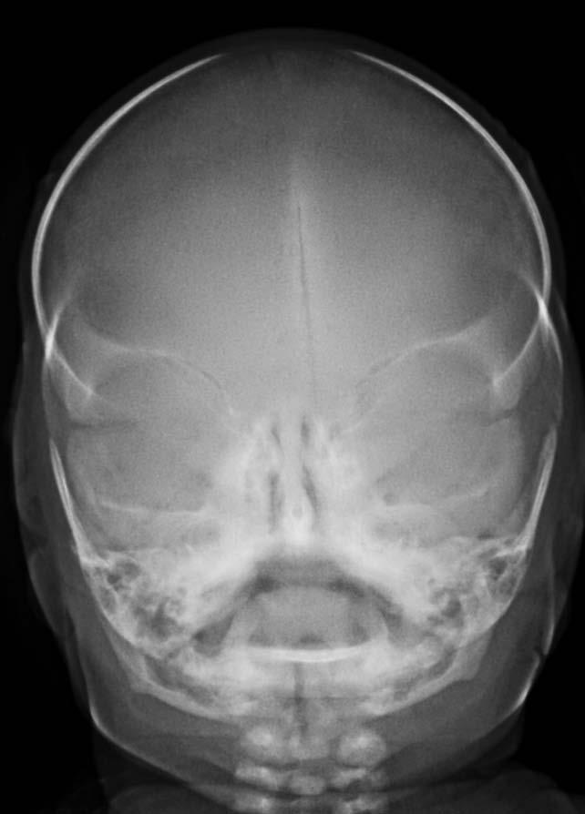 Craniosynostosis Definition: Premature fusion of cranial sutures