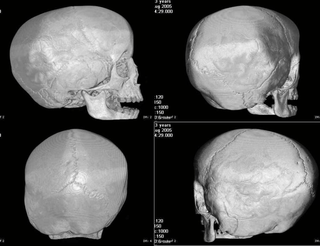 abnormally shaped head Diagnosis: