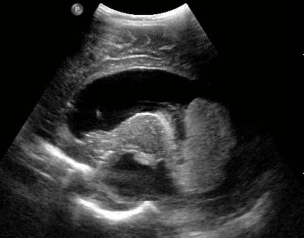 4-month-male with macrocephaly