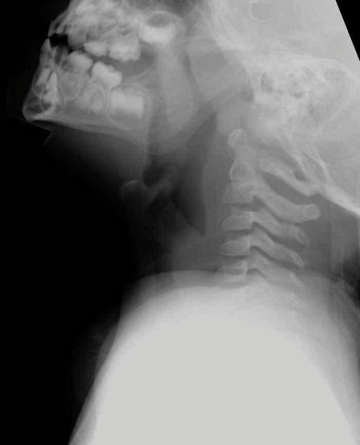 Torticollis with fever Axial CT neck demonstrates fluid pockets both on