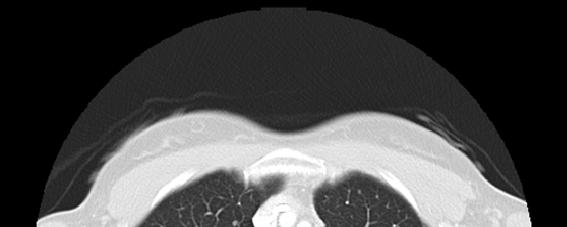 Novel TRIM33 RET Fusion: Results Baseline CT scan showing