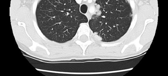 disappearance of paramediastinal and near complete