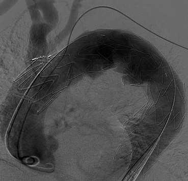 Occlusion of the carotid-subclavian bypass was noted intra-operatively Origin of the LSCA was not effectively ligated Retrograde coil