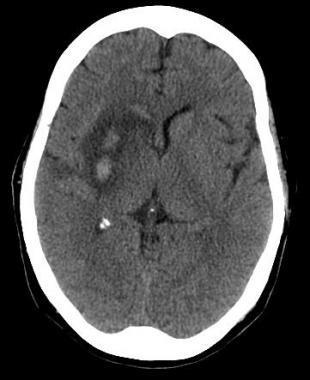 Stroke in TEVAR Incidence 3-11% Anterior/posterior circulation Silent undetected strokes up to 60% Mechanism of stroke unclear Feezor et