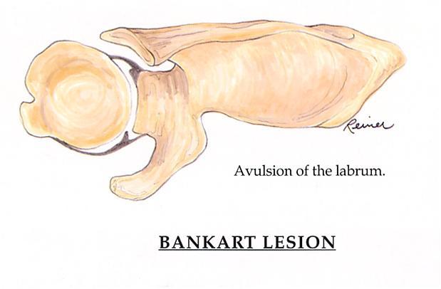Banckart Lesion Complication