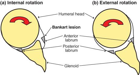 detachment -Bankart lesion following anterior shoulder