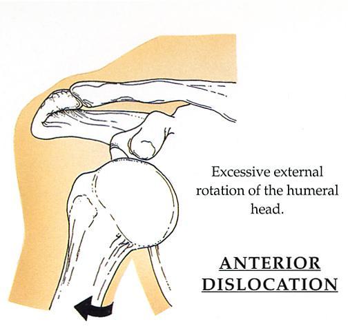 Anterior Subluxations Dislocation most common traumatic dislocation in the human body High recurrence rate: 47%- 100%