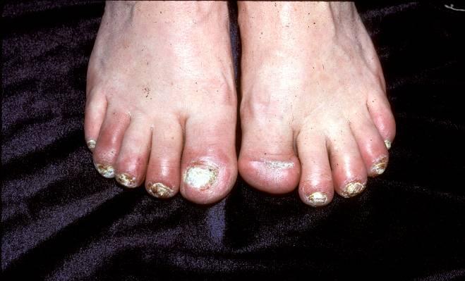 Differential Diagnosis Psoriasis commonly