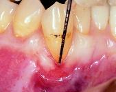 Surgical Treatment of Gingival Recession and Stability of the Results 6 IV-6-4 Root coverage and pocket elimination Root coverage a1 One year