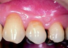 IV Restorative Therapy and Maintenance of Gingival and Periodontal Tissues g h Preoperative 2 years and 7 months