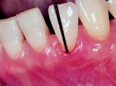 years and 2 months after surgery (03/1998): From the third year on, the gingival margin migrated coronally and then