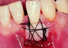 a c e b d f IV-6-3 Free gingival graft procedure for recession coverage* a Tooth 32 exhibited Class I recession