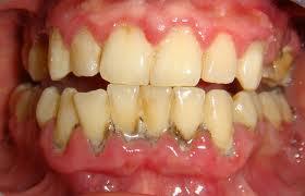 Full mouth debridement to enable comprehensive evaluation and diagnosis D4355 The gross removal of plaque and calculus that interfere with the