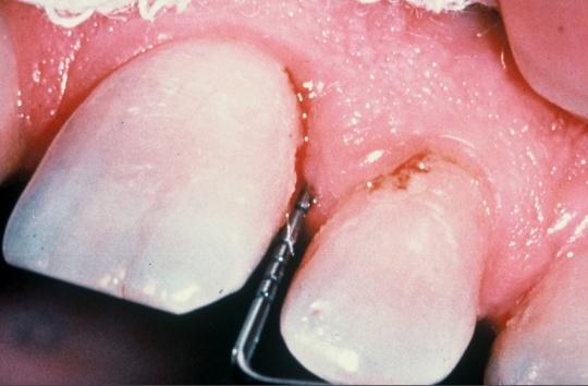 depth Continued attachment loss (i.e. recession) Increased tooth mobility