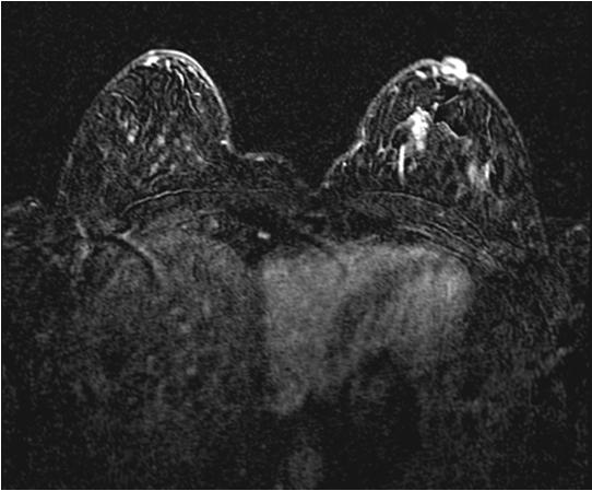 Breast MRI Lower specificity ~ 30 60% PPV Some benign