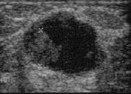 3% Internal echoes blood or septae (Category 2) Intra-cystic nodule or