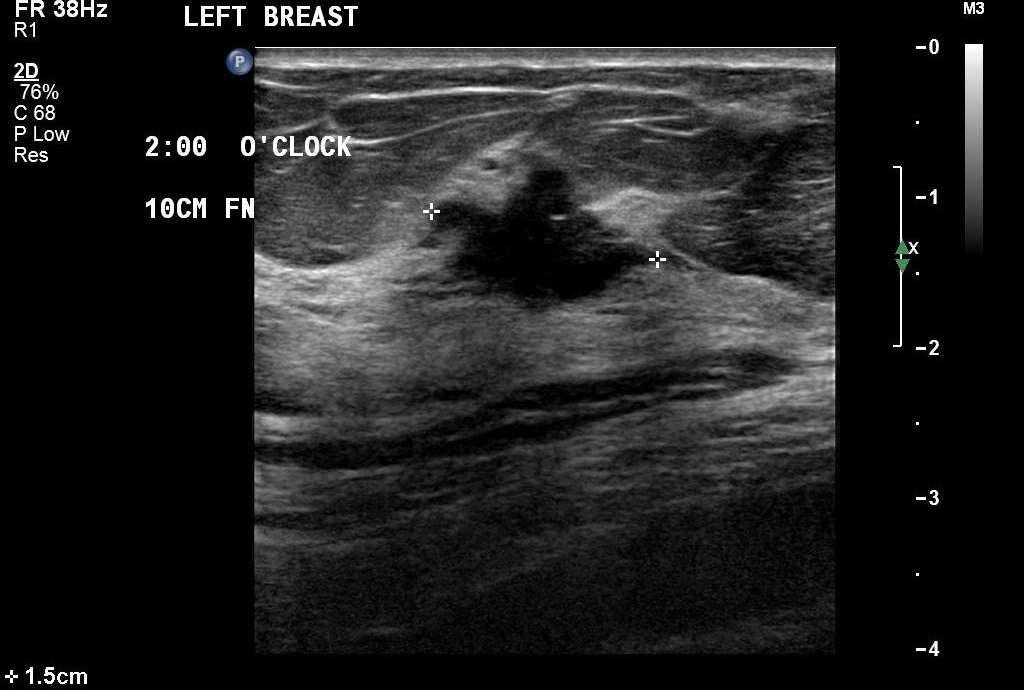 BREAST CANCER MAMMOGRAPHY BREAST SCREENING WOMEN >40 YEARS ( TARGET 50-74 YO) FULL FIELD (2D) DIGITAL MAMMOGRAPHY