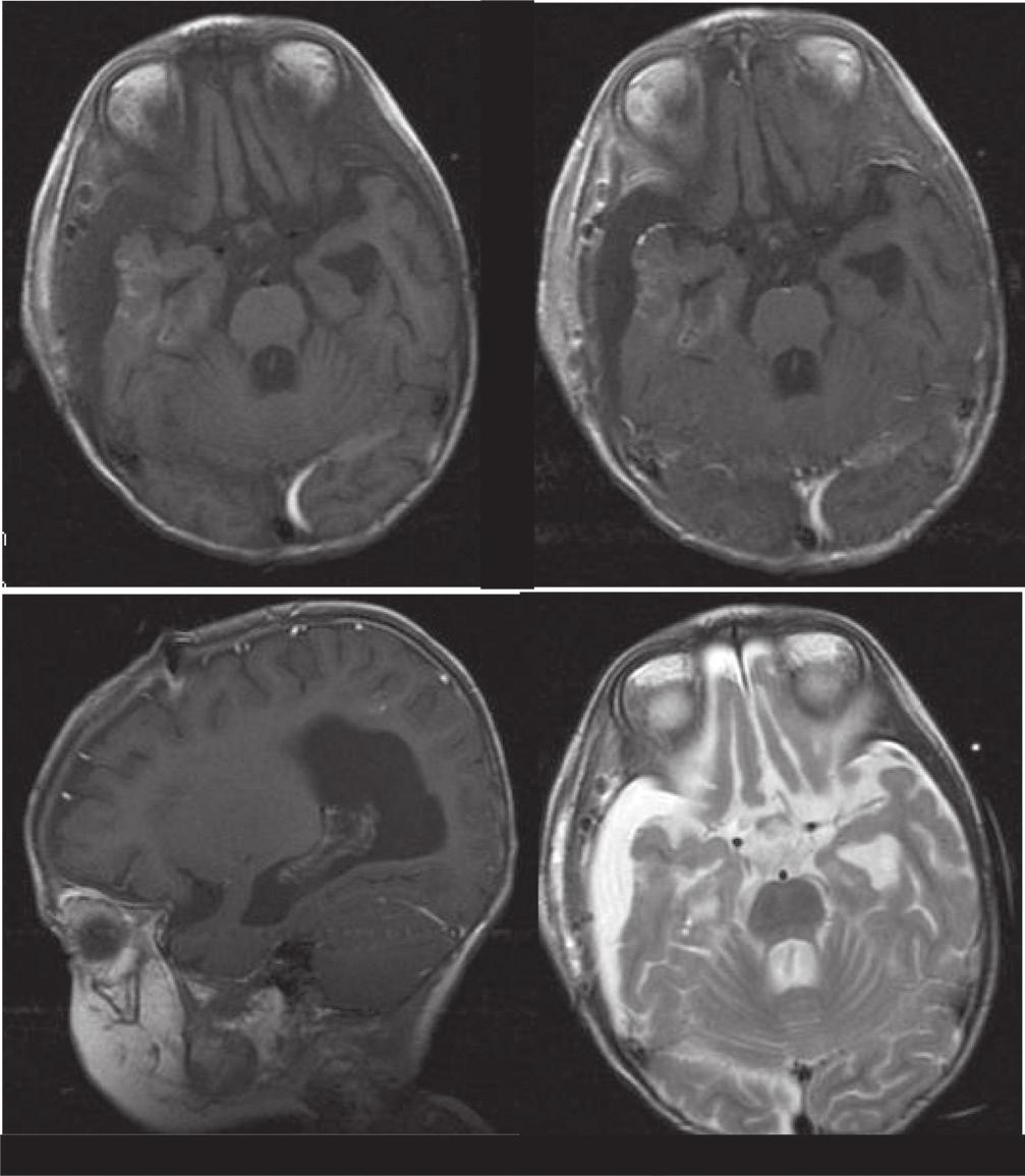 Pathological examination revealed it to be a choroid plexus papilloma (Fig. 3). Postoperative MRI demonstrated total removal of the lesion (Fig. 4).