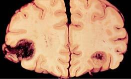 Metastatic Carcinoma Account for about 30% of adult brain tumors