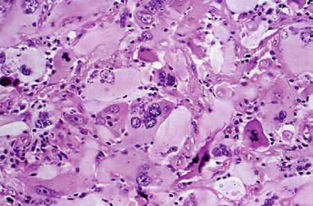 Giant cell GBM p53 EGFR Low Grade Diffuse Astrocytoma Peak age of incidence
