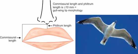 Ashok Surana et al Fig. 1: Assessment of gull-wing lip morphology lower lid lash to the supratarsal crease. The upper lip length measured from subnasale to upper lip inferior is usually 19 to 22 mm.