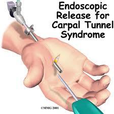 of clients with CTS Involves nerve decompression OCTR (open carpal