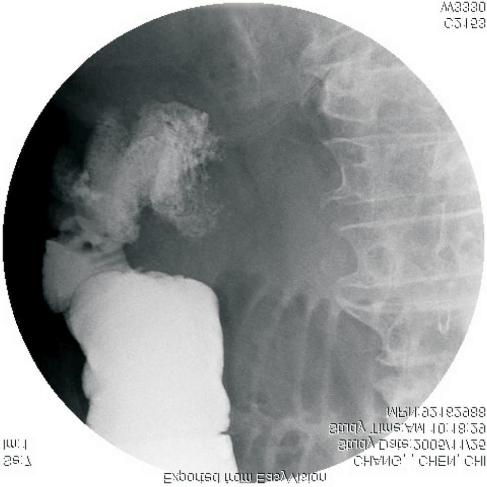 His abdomen featured distension with a ball-shaped appearance, and was moderately tender in the right lower quadrant. His bowel sounds are hyperactive with occasional high-pitched tones.