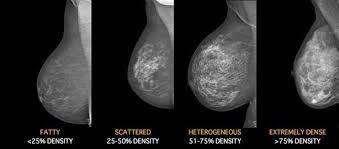 Background Breast cancer advocates in many states have lobbied for patient notification about increased breast density because It is a marker of increased risk The sensitivity of mammograms