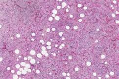 Clinical: Myxoid liposarcoma Myxoid liposarcoma Variably cellular, plexiform vasculature,