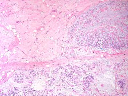 round cell lesions Adjuvant chemotherapy followed by wide excision Histopathology: Myxoid