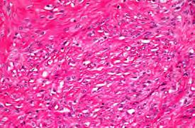 epithelioid fibrosarcoma Sheets, nests and cords of monomorphic