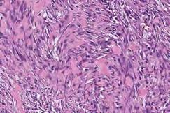 fibroblasts and myofibroblasts Common,