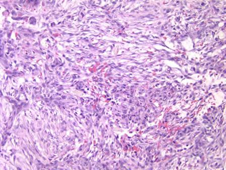 Numerous mitoses especially in early lesions, not atypical forms Prominent inflammation around lesion