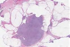 mitoses with atypical forms, distinct curvilinear vessels MPNST More atypia, higher cellularity, SOX10 & S100