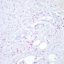 Plumper cells, not extensively myxoid